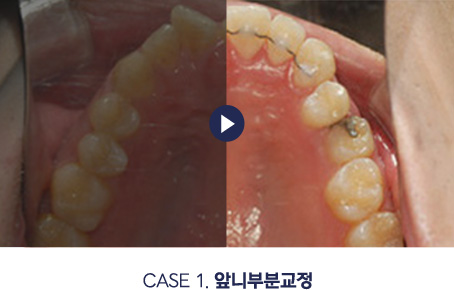 앞니부분교정