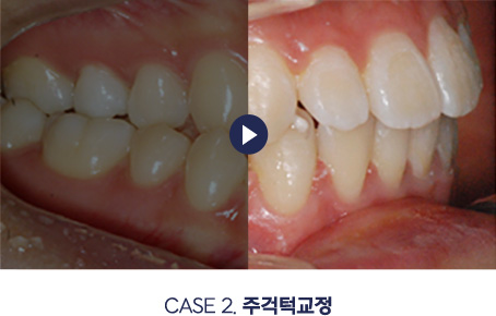 주걱턱교정