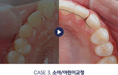 소아/어린이교정