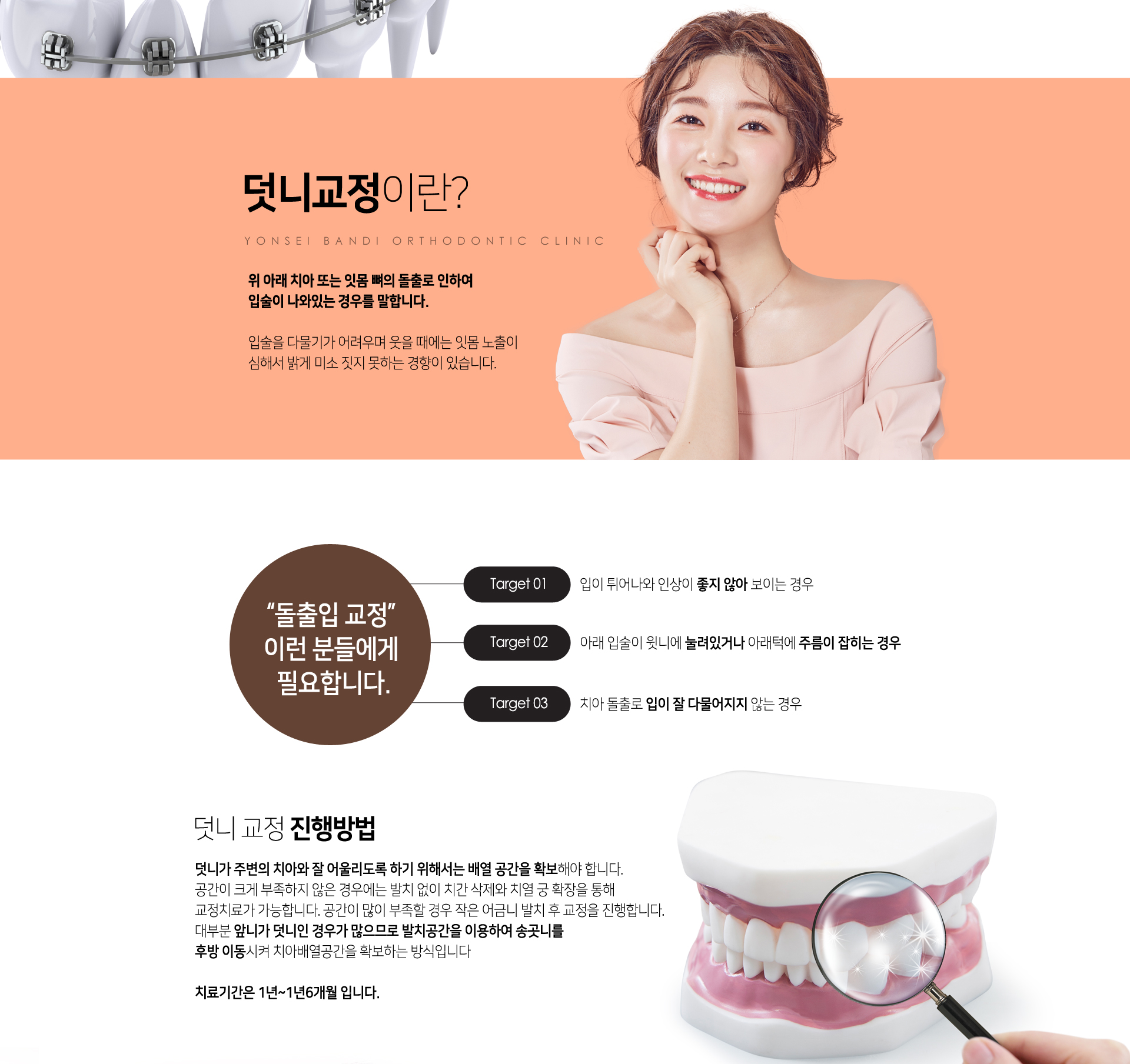 덧니교정이란? 위아래 치아 또는 잇몸 뼈의 돌출로 인하여 입술이 나와있는 경우를 말합니다. 덧니가 주변의 치아와 잘 어울리도록 하기 위해서는 배열 공간을 확보해야 합니다. 공간이 크게 부족하지 않은 경우에는 발치없이 치간삭제와 치열 궁 확장을 통해 교정치료가 가능합니다. 공간이 많이 부족할 경우 작은 어금니 발치 후 교정을 진행합니다. 대부분 앞니가 덧니인 경우가 많으므로 발치공간을 이용하여 송곳니를 후방이동시켜 치아배열공간을 확보하는 방식입니다. 치료기간은 1년~1년 6개월입니다.
