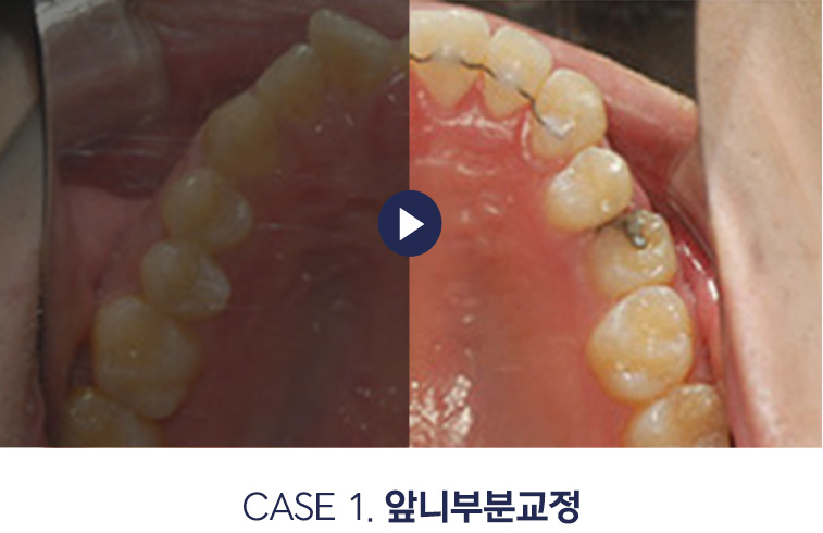앞니부분교정