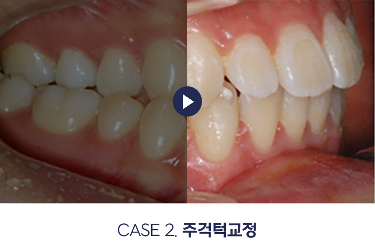 주걱턱교정