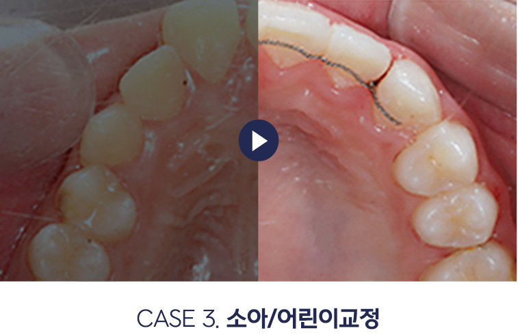 소아/어린이교정